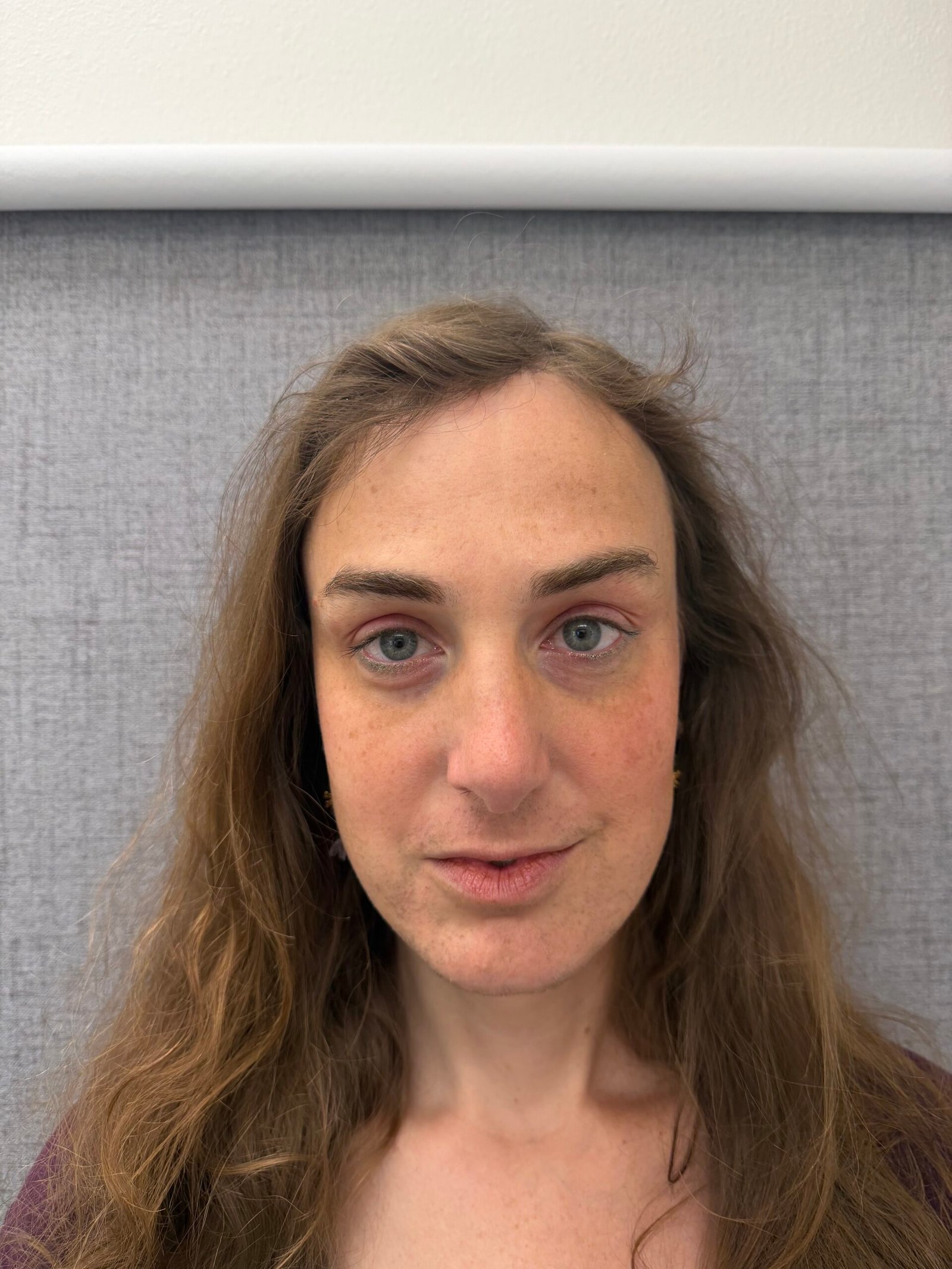 Facial Feminization Surgery After