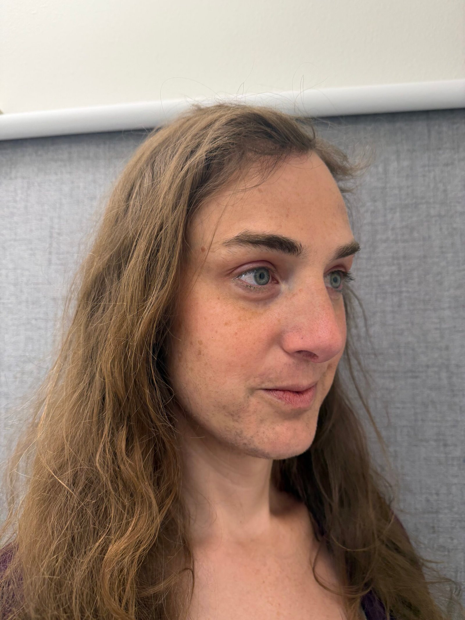 Facial Feminization Surgery After