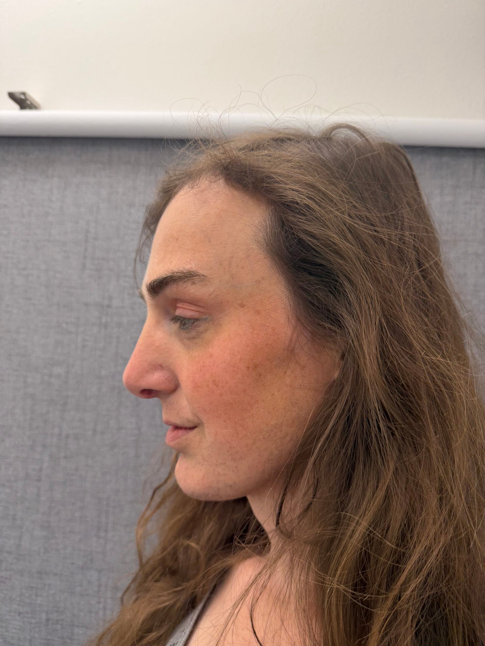 Facial Feminization Surgery After