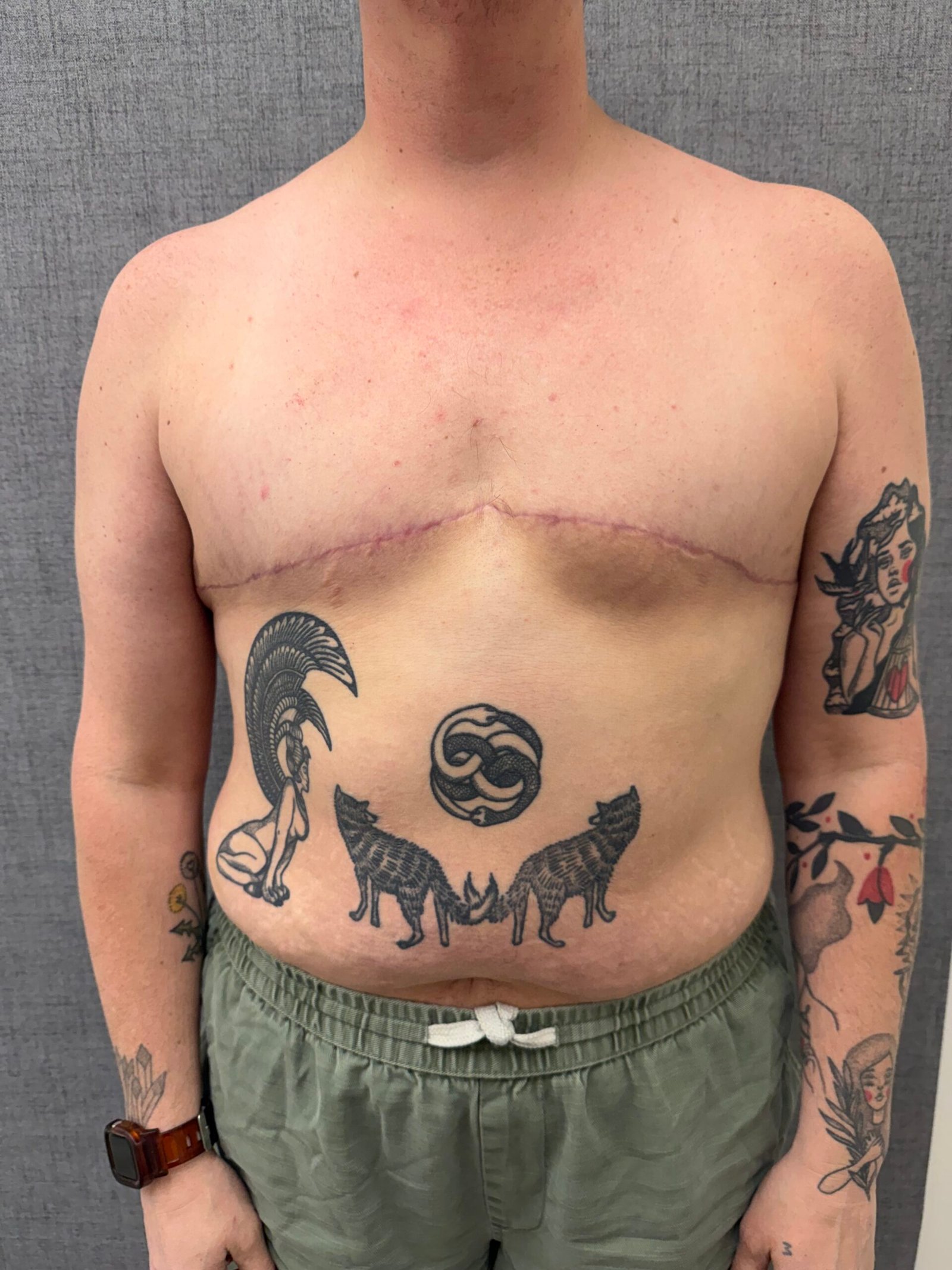 Gender-Affirming Breast Reduction After