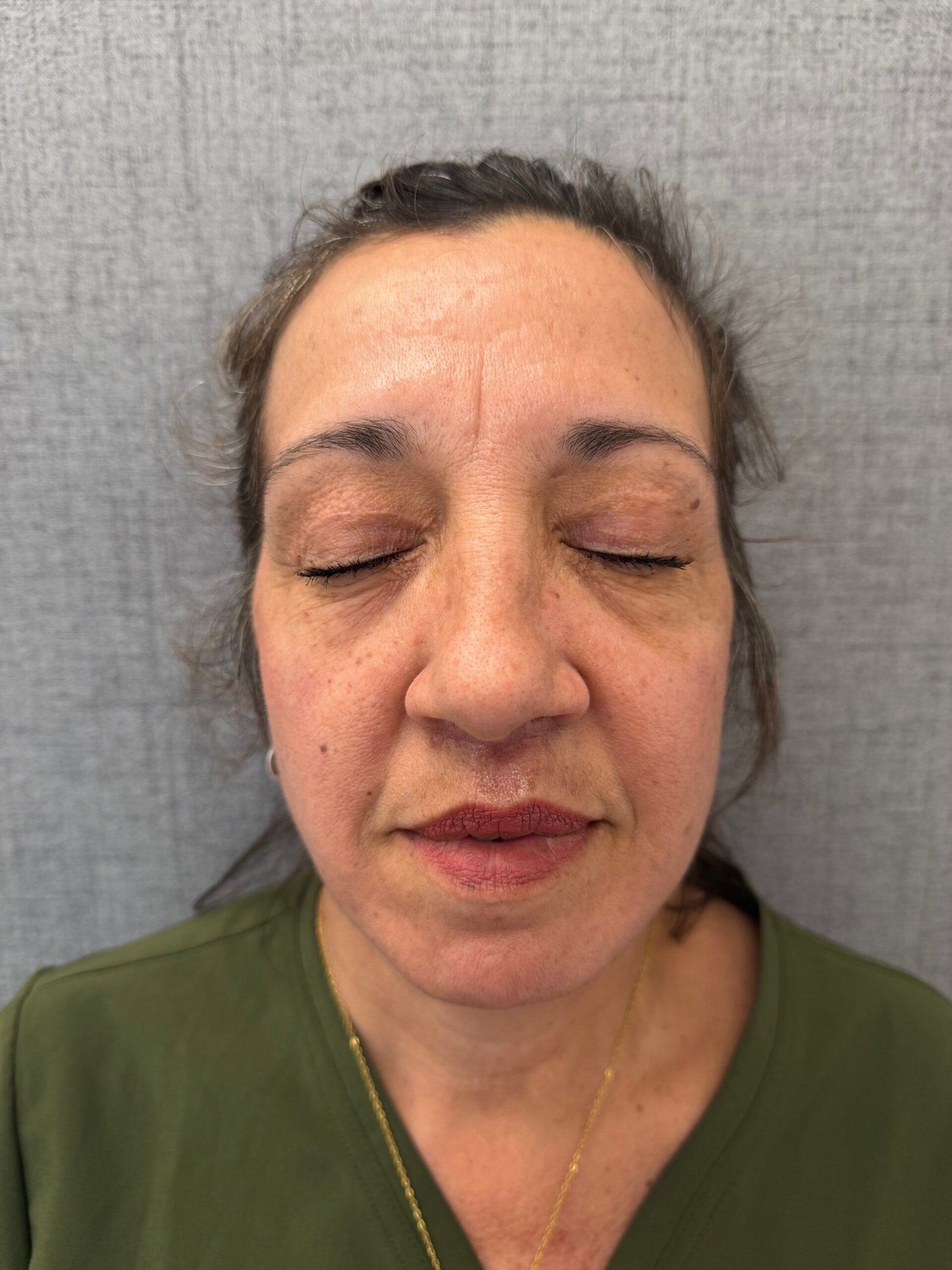 Lip Lift After
