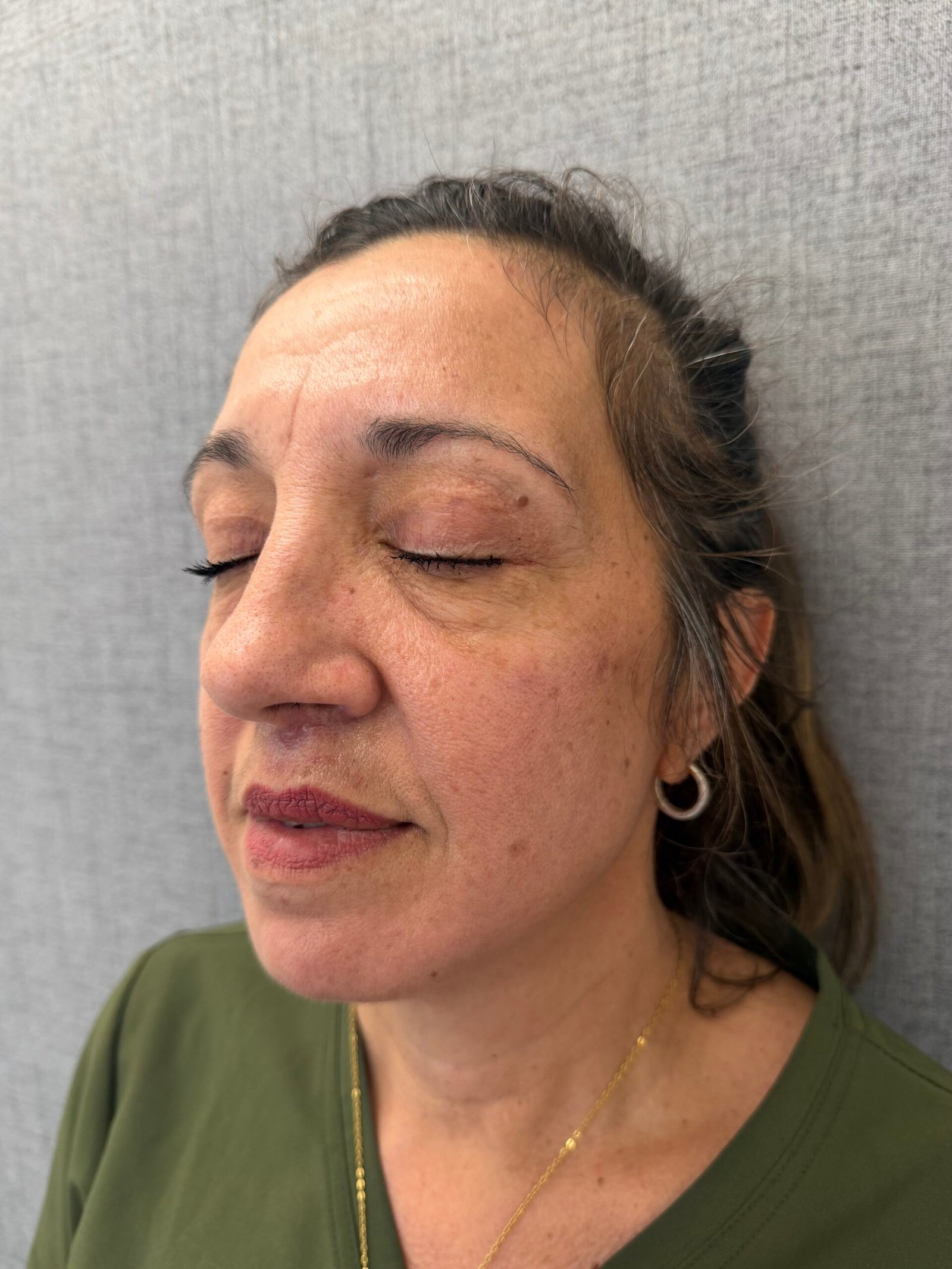 Lip Lift After