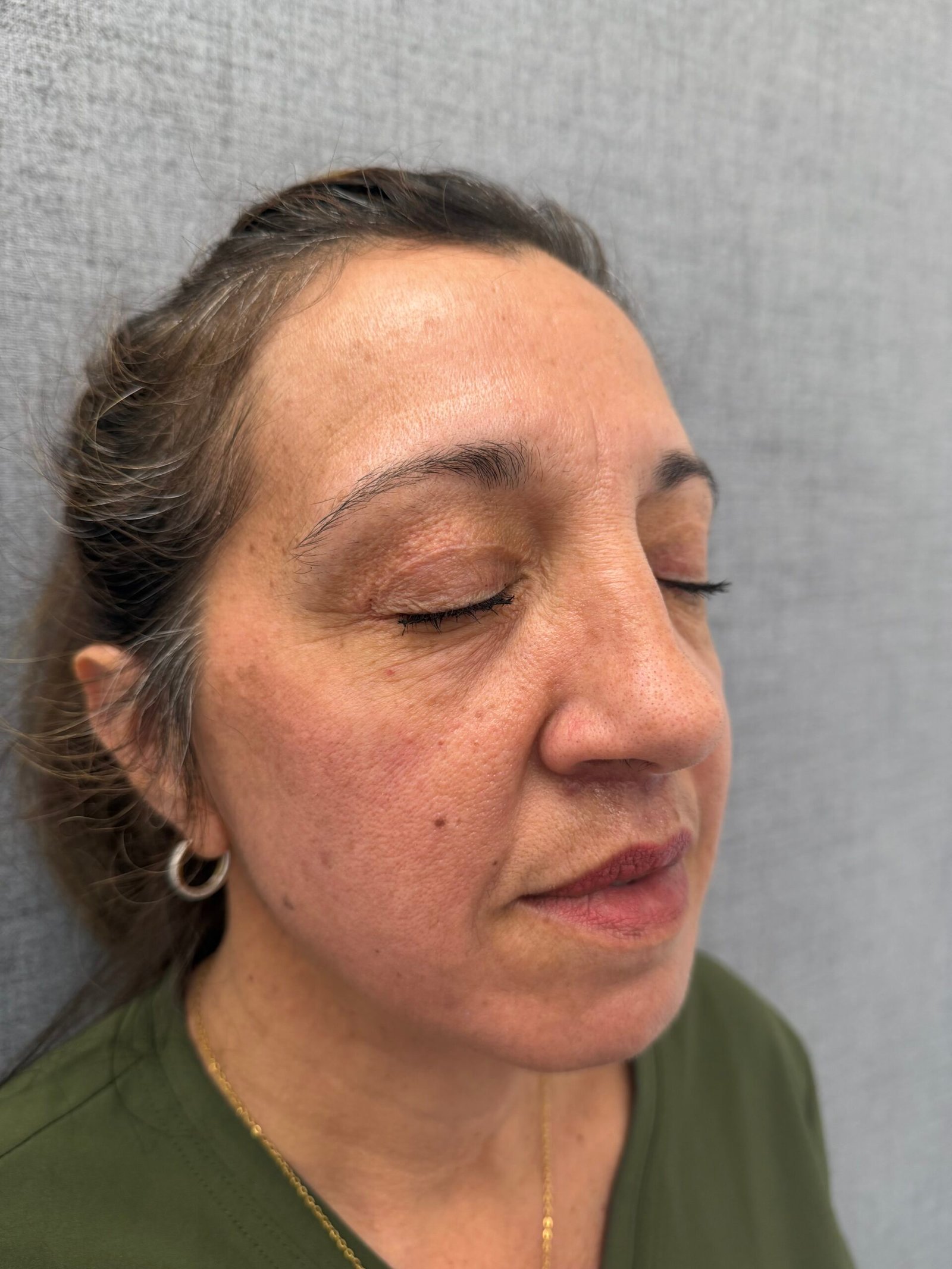 Lip Lift After