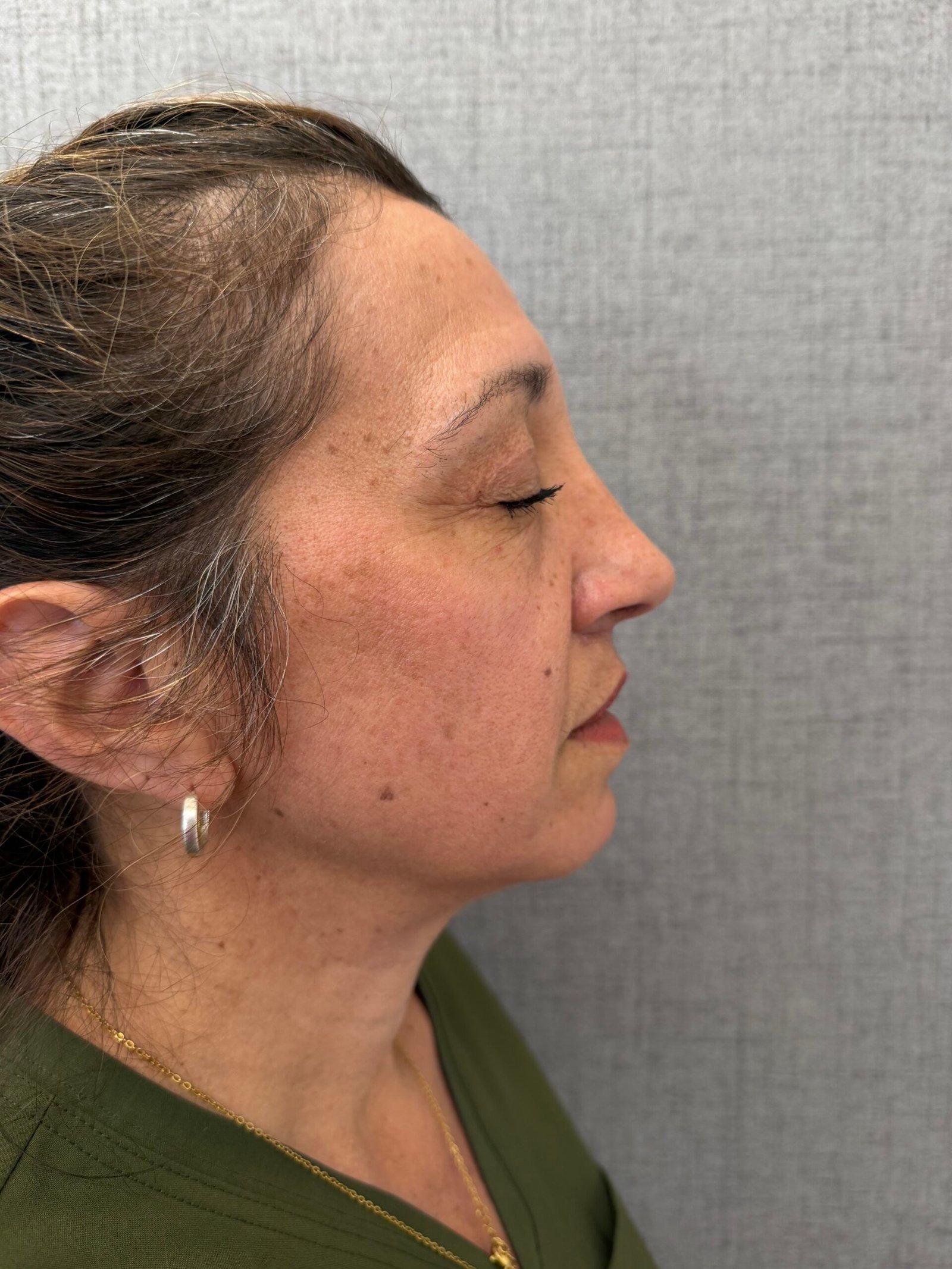 Lip Lift After