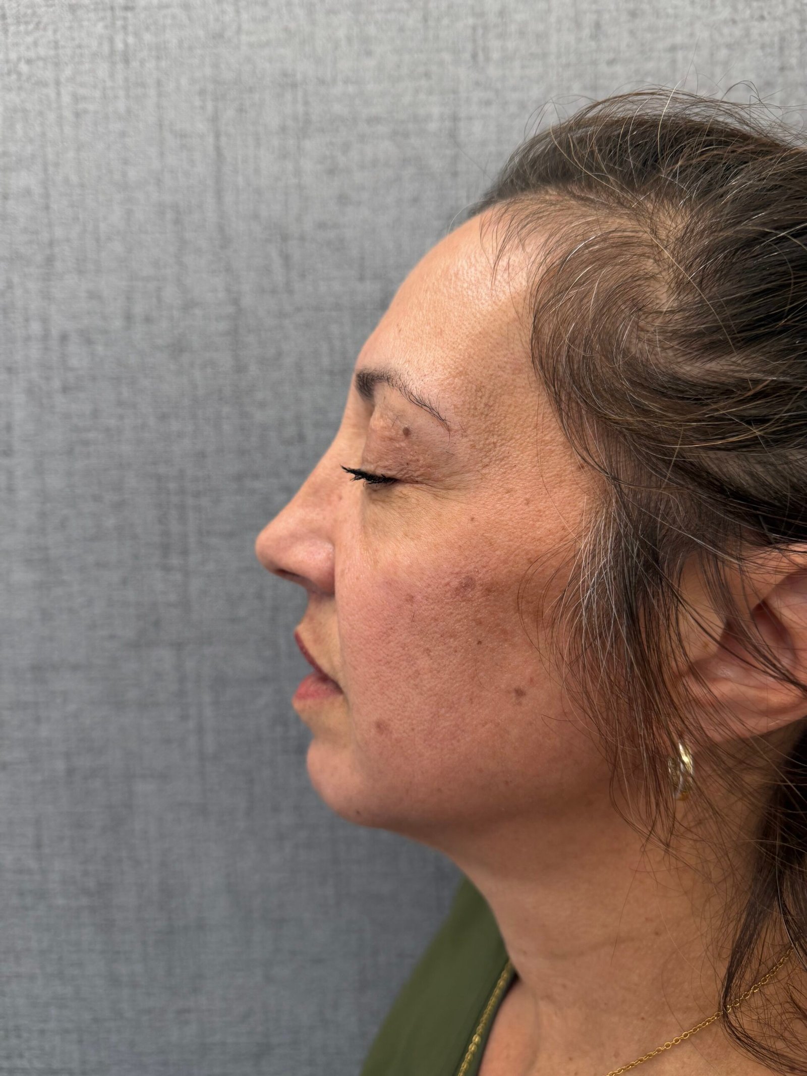 Lip Lift After