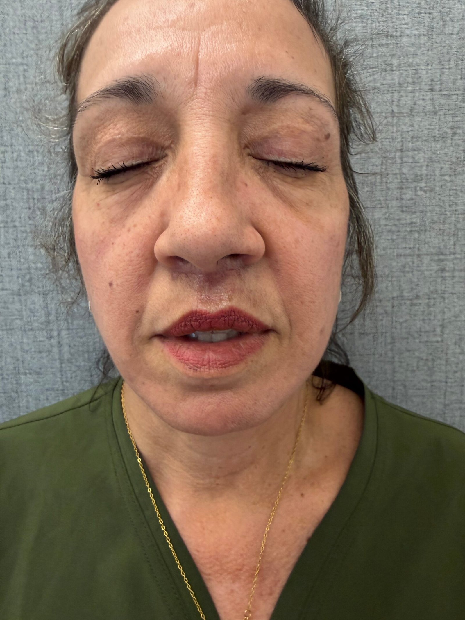 Lip Lift After