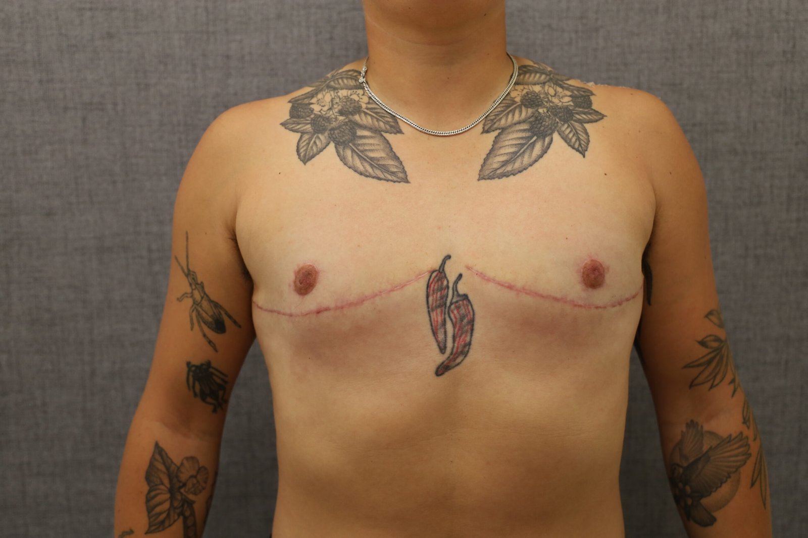 Gender-Affirming Breast Reduction After