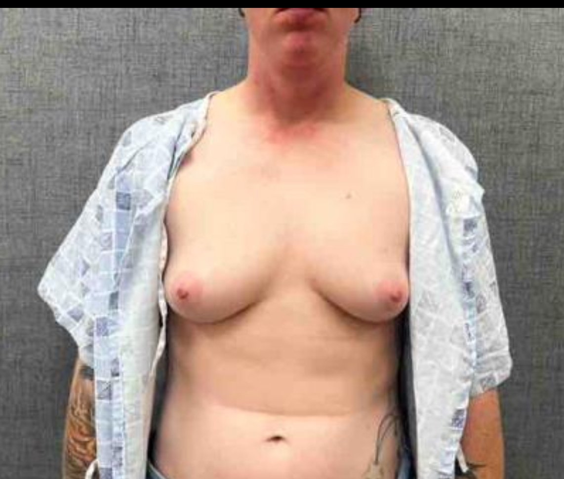 Gender-Affirming Breast Reduction Before