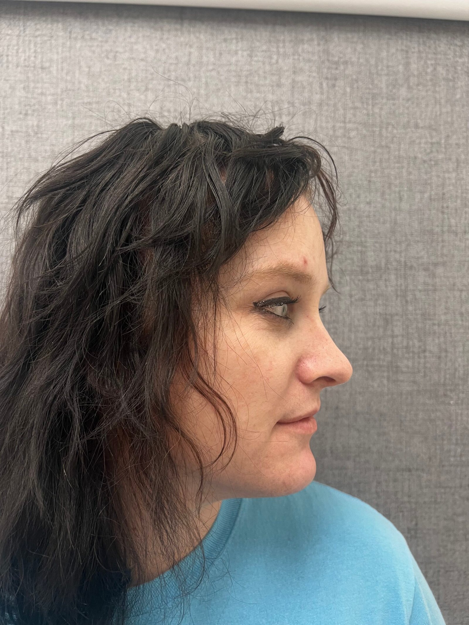 Facial Feminization Surgery After