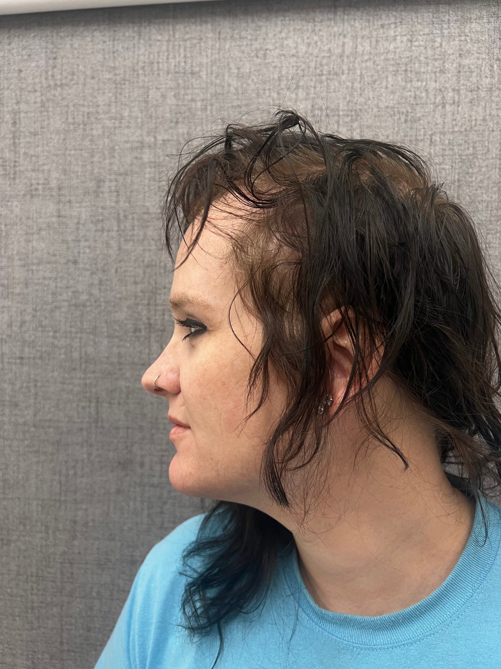 Facial Feminization Surgery After