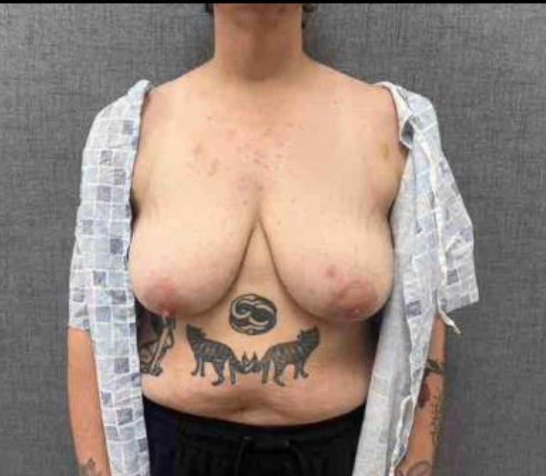 Gender-Affirming Breast Reduction Before