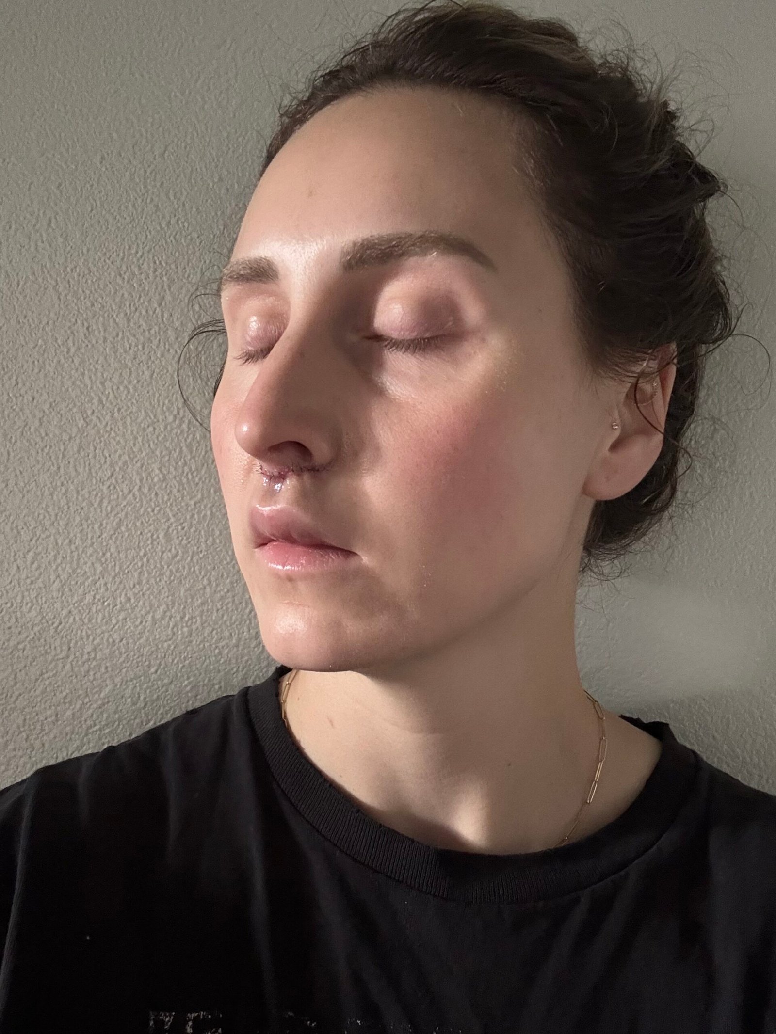 Lip Lift After